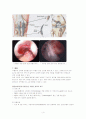 전방십자인대 파열(Anterior cruciate ligament(ACL) rupture) case study 4페이지
