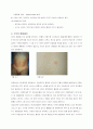수두 Chickenpox(Varicella) 2페이지