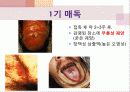 매독(피부과) 파워포인트 정리요약본 5페이지