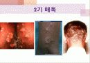 매독(피부과) 파워포인트 정리요약본 8페이지