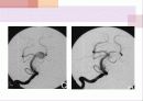  SAH disease review ppt 8페이지