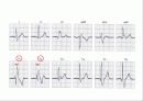 심전도[Electrocardiogram , ECG, 心電圖, EKG]  24페이지