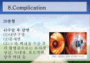 백내장 원인과 종류, 수술후 간호  19페이지