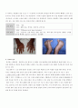 CASE STUDY(류마티스관절염) 6페이지