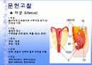 자궁근종 case  4페이지