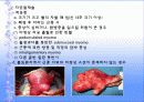 자궁근종 case  13페이지