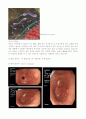 성인간호학 케이스스터디 위이형성 5페이지