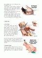 수근관 터널 증후군(carpal tunnel syndrome.CTS) 4페이지