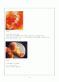 [간호학]유산(abortion) 4페이지