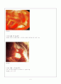 [간호학]유산(abortion) 5페이지