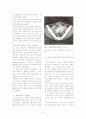 자궁내피임장치(IUD)의 합병증과 적용 4페이지