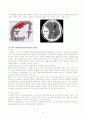 SDH&EDH에 관한 질병 고찰 및 case study(SICU) 4페이지