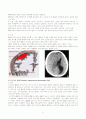 SDH&EDH에 관한 질병 고찰 및 case study(SICU) 5페이지