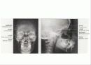뒤통수뼈(occipital bone) 관자뼈(temporal bone) 나비뼈(sphenoid bone) 15페이지