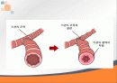 기관지천식 최강 ppt 5페이지