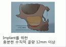 상악동 거상술 4페이지