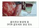 상악동 거상술 18페이지