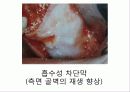 상악동 거상술 20페이지