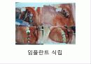 상악동 거상술 21페이지