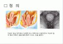 Uterine prolapse (자궁탈수증, 자궁탈출증) 3페이지