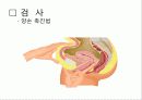 Uterine prolapse (자궁탈수증, 자궁탈출증) 9페이지