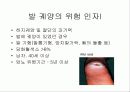 당뇨병환자의 발 관리 PPT 5페이지