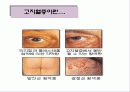고지혈증에 대한 내용 3페이지