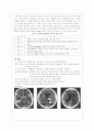 지주막하 출혈 SAH(Subarachnoid Hemorrhage) 간호케이스 2페이지