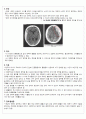 성인간호학 (신경외과) SAH 2페이지