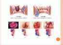 Hemorrhoid 치핵 9페이지