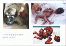 낙태 (落胎, abortion) 5페이지