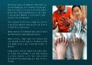 희귀병의 종류 그 특징과 증상-조로증후군,지방이영양증,손,발가락 과다증,에스트로겐의 과다분비,몸에서 피가 나는 병,-어린선,-기관총 재채기 증후군,,-배설강외번증,-후신,경모세포종,-프라더 윌리 증후군,-유전성 거대 백악질,-크루존 증후군, 8페이지