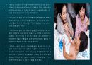 희귀병의 종류 그 특징과 증상-조로증후군,지방이영양증,손,발가락 과다증,에스트로겐의 과다분비,몸에서 피가 나는 병,-어린선,-기관총 재채기 증후군,,-배설강외번증,-후신,경모세포종,-프라더 윌리 증후군,-유전성 거대 백악질,-크루존 증후군, 18페이지