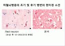 뇌혈관질환의 병리  20페이지