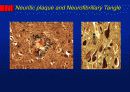 Alzheimer’s disease 20페이지
