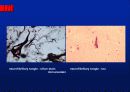Alzheimer’s disease 21페이지