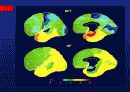 Alzheimer’s disease 24페이지