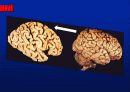 Alzheimer’s disease 25페이지
