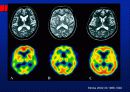 Alzheimer’s disease 37페이지