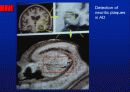 Alzheimer’s disease 39페이지