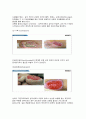 상처간호 - 상처의 정의, 치유과정, 기본 원칙, 사정과 기록, 욕창 간호 관리 6페이지