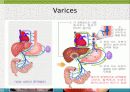 GI bleeding conference 18페이지