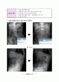 Case study - Compression fracture 8페이지