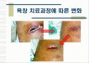 욕창관리 및 예방 18페이지