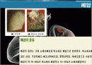 암의 종류 및 동맥스텐트시술에 대하여.ppt 5페이지