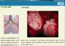 암의 종류 및 동맥스텐트시술에 대하여.ppt 6페이지