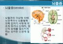 암의 종류 및 동맥스텐트시술에 대하여.ppt 14페이지