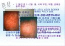 수두 발표자료 2페이지