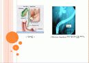 ERCP : 내시경적 역행성 췌담관 조영술 (Endoscopic retrograde cholangiopancreatography) 6페이지
