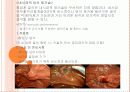 ERCP : 내시경적 역행성 췌담관 조영술 (Endoscopic retrograde cholangiopancreatography) 8페이지